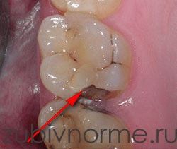 Sigiliul de la un dinte a renunțat la ceea ce trebuie făcut sau făcut înainte de referire la medic