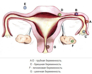 Méhen kívüli terhesség tünetei - kezelésére emberek jogorvoslatok