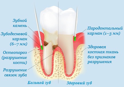 Хірургічне та медикаментозне лікування ясенних кишень