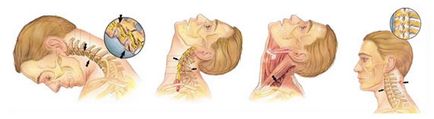 Whiplash la nivelul gâtului (coloana vertebrală), consecințe