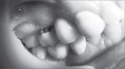 Înlocuirea defectelor terminale și a defectelor incluse în dentiție cu modele de proteze nedemontabile pe