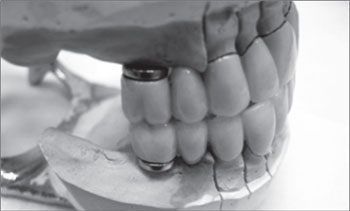 Înlocuirea defectelor terminale și a defectelor incluse în dentiție cu modele de proteze nedemontabile pe