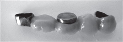 Заміщення кінцевих і включених дефектів зубних рядів незнімними конструкціями протезів на