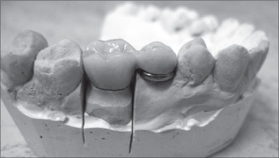 Заміщення кінцевих і включених дефектів зубних рядів незнімними конструкціями протезів на
