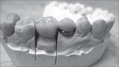 Înlocuirea defectelor terminale și a defectelor incluse în dentiție cu modele de proteze nedemontabile pe