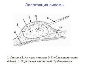 Жировики на пеніса - наскільки небезпечні, як позбутися від жировик на члені