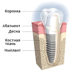 Зубні імпланти з цирконію, медицина очима обивателя