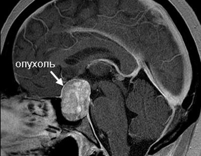 Adenomul glandei pituitare a creierului, simptome