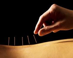 Acupunctura in stomatologie, stomatologie, Everest in St. Petersburg