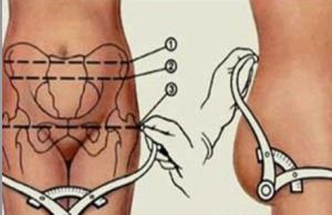 Sarcina anatomică și clinic îngustă a sarcinii pelvisului și a nașterii