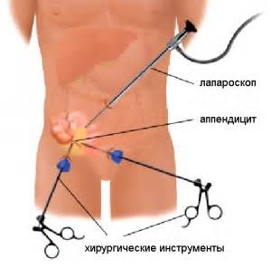 Apendicita simptome, semne, cauze de apendicita, metode de indepartare a apendicitei,