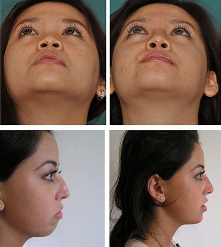 Rinoplastia non-chirurgicală, contraindicații, fotografii, prețuri