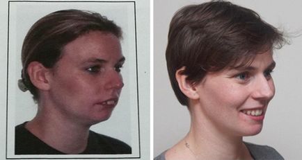 Bretele înainte și după (41 fotografii)
