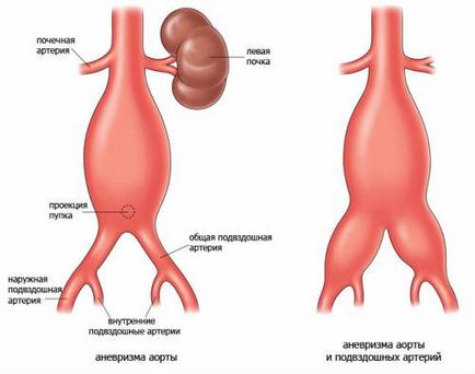 Abdominală aorta de ce pulsuri, simptome de anevrism și ateroscleroză, operație