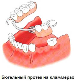 Бюгельне протезування зубів (виготовлення та встановлення), зубні протези бюгелі на замках