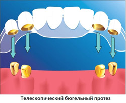 Бюгельне протезування зубів (виготовлення та встановлення), зубні протези бюгелі на замках