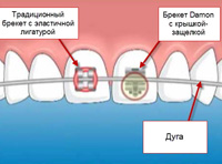 Sistemul de protecție a dinților (fabricarea și instalarea), protecția danturii la încuietori