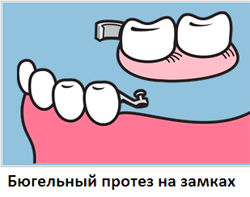 Бюгельне протезування зубів (виготовлення та встановлення), зубні протези бюгелі на замках