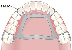 Részleges fogsor fogai (gyártása és szerelése), fogsorok kapcsok a zárak