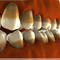 Placa neagră cauzată de dinți provoacă tratament