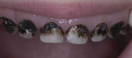 Чорний наліт на зубах причини, лікування