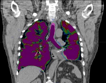 Ce arată mrt, CT (tomografie computerizată) a plămânilor