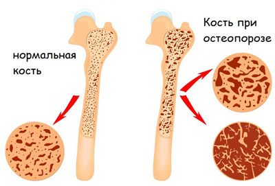 Що таке білкове отруєння симптоми, лікування