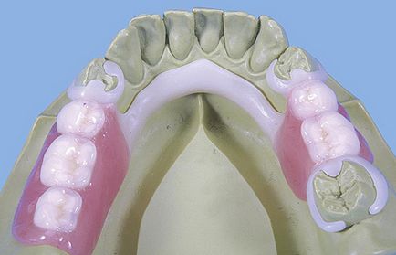 Dentalab - proteză termoplastică