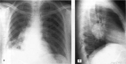 Diagnosticul și tratamentul sindromului prezenței cavității (țesuturilor) în țesutul pulmonar