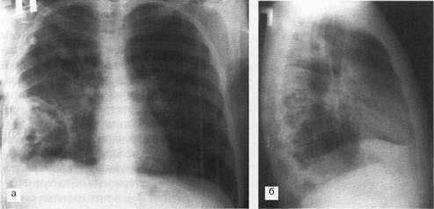 Diagnosticul și tratamentul sindromului prezenței cavității (țesuturilor) în țesutul pulmonar
