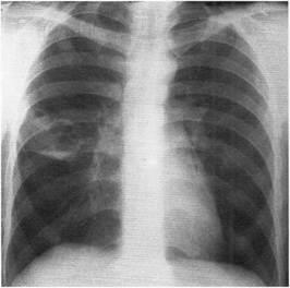 Diagnosticul și tratamentul sindromului prezenței cavității (țesuturilor) în țesutul pulmonar