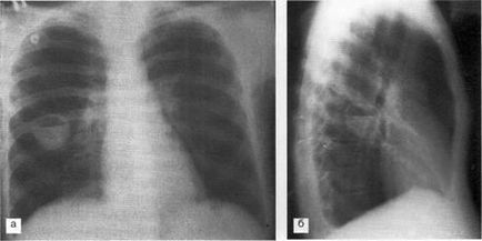 Diagnosticul și tratamentul sindromului prezenței cavității (țesuturilor) în țesutul pulmonar