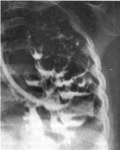 Diagnosticul și tratamentul sindromului prezenței cavității (țesuturilor) în țesutul pulmonar