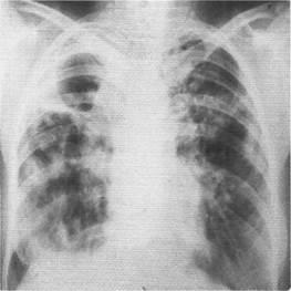 Diagnosticul și tratamentul sindromului prezenței cavității (țesuturilor) în țesutul pulmonar