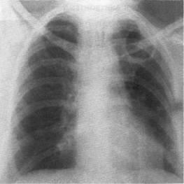 Diagnosticul și tratamentul sindromului prezenței cavității (țesuturilor) în țesutul pulmonar