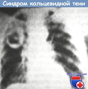 Diferențierea umbrei în formă de inel pe radiografia pieptului