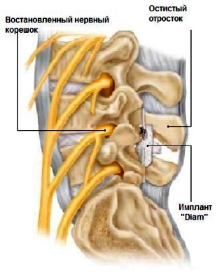 Diam Stabilizarea dinamică a coloanei vertebrale - sfaturi pentru pacienți