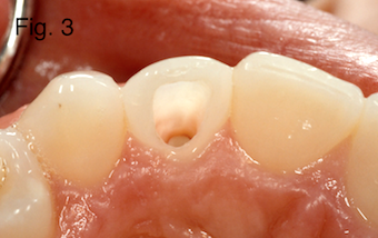 Дисколорація ендодонтично лікування зубів