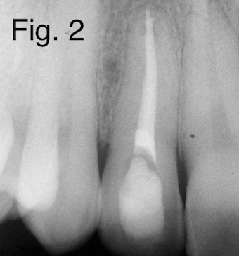 Дисколорація ендодонтично лікування зубів