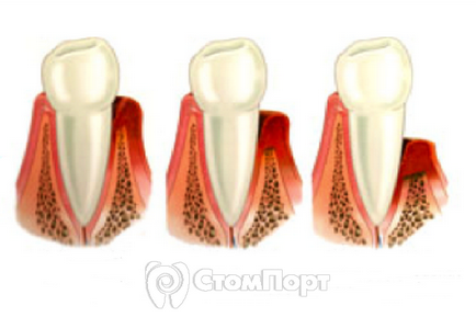 Decolorarea țesuturilor dinte care rezultă din tratamentul endodontic