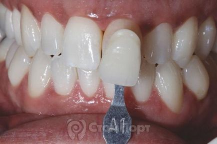 Diskoloratsiya fogszövetekkel kapott endodontikus