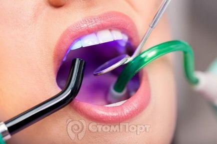 Decolorarea țesuturilor dinte care rezultă din tratamentul endodontic