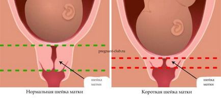 Lungimea cervicală la norma sarcinii, predicții