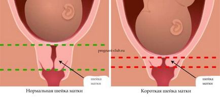 méhnyak hossza terhességi arány előrejelzések