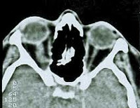 Endoteliom - cauze, simptome, diagnostic și tratament