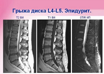 Epiduritisul coloanei vertebrale, purulent, tratament, cauze, simptome, cicatricial, adeziv, cronic,