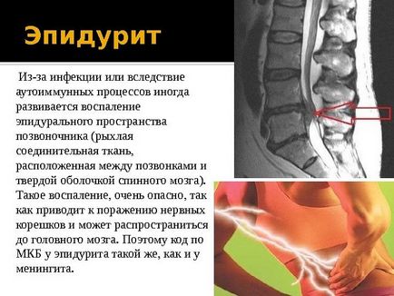 Epiduritisul coloanei vertebrale, purulent, tratament, cauze, simptome, cicatricial, adeziv, cronic,