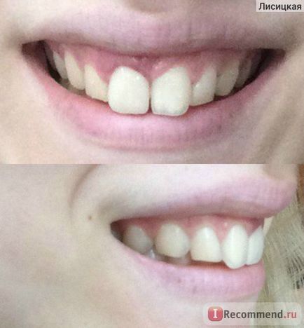 Esztétikai fogászat - Art helyreállítása a fogak - „most meg kell tanulni, hogyan kell mosolyogni