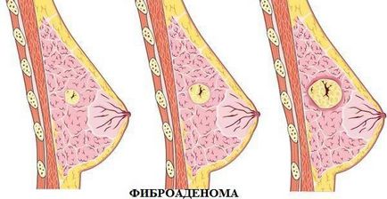 Fibroadenomul glandei mamare determină apariția, simptomele și tratamentul