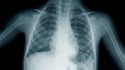 Форми і види туберкульозу легенів